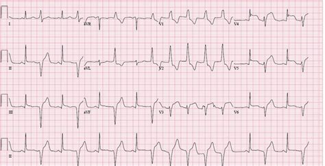 Ecg With Anterolateral And Inferior St Segment Elevation Download