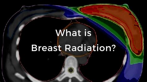 What Is Breast Radiation The Breast Cancer School For Patients