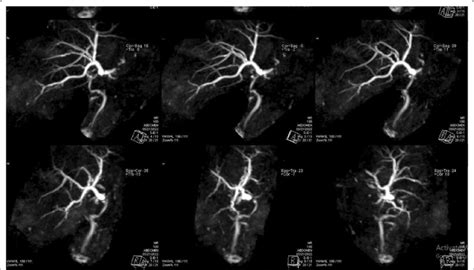 Mrcp Images Showing Mild Intrahepatic Biliary Channels Dilatation With