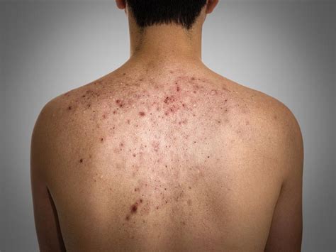 15 Home Remedies For Pimples On Back Styles At Life