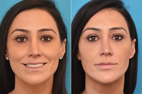 Injectable Fillers Photos Philadelphia Pa Patient 3764