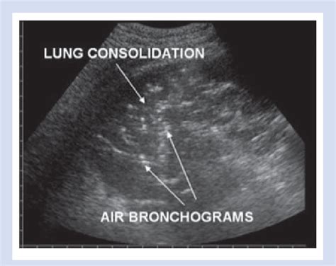 Ultrasound Imaging Of The Patients Lung It Shows An Area Of
