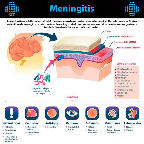 Qué es la meningitis Te explicamos las causas el origen y los Hot Sex