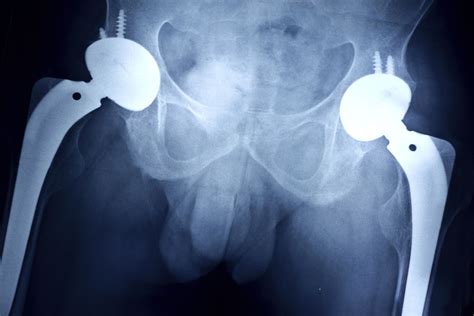 Cms New Model For Hip Knee Replacement Payments Us News