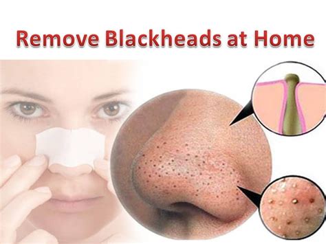 How To Remove Blackheads From Nose Get Rid Of Blackheads Naturally At