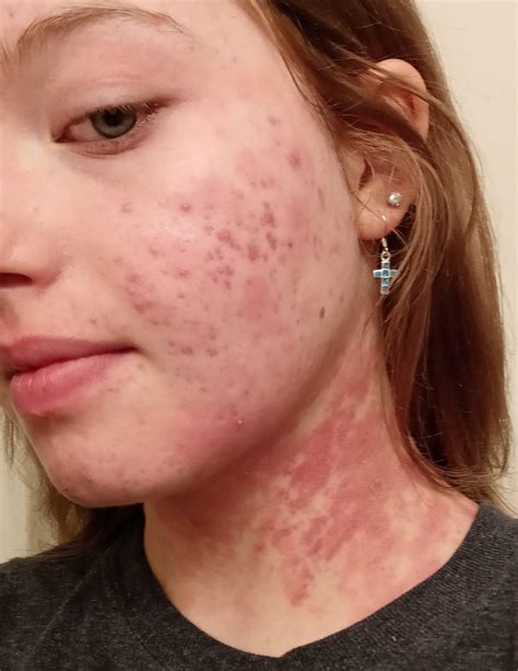 Skin Concern Has Anyone Here Had Pityriasis Rosea Before