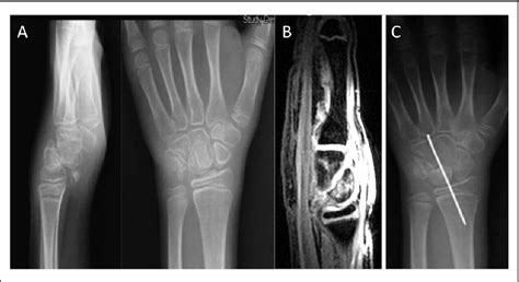 Traumatic Midcarpal Dislocation In An 8 Year Old Girl Semantic Scholar