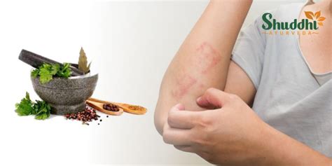 Home Remedies For Skin Rashes Archives Shuddhi