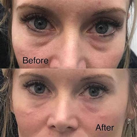 Tear Trough Under Eye Filler Before And After All You Need Infos