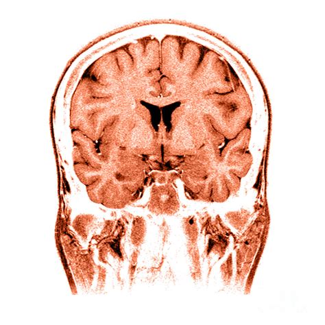 Normal Coronal Mri Of The Brain Photograph By Medical Body Scans Fine