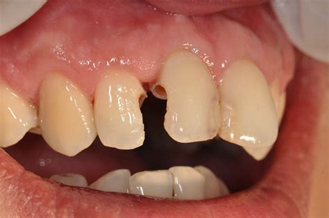 Cases Of Restoration With Composite Resin Prestige Dental My