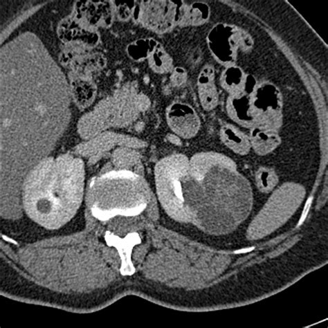 Ct And Mr Imaging For Evaluation Of Cystic Renal Lesions And Diseases