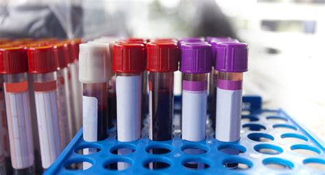 What Do Your Lab Test Results Mean Uci Health Orange County Ca