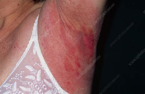 Allergic Reaction To Armpit Deodorant Stock Image M3200192