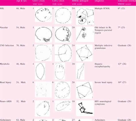 Moca scoring nuances with clock draw Clock drawing and MMSE pentagons in various neurological disorders | Download Table