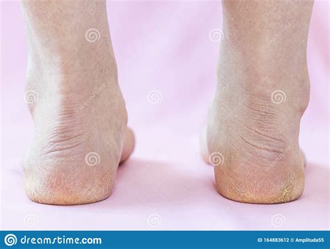 Legs Female With Dry Cracked Skin On A Pink Background Stock Photo