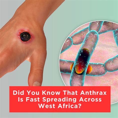 Did You Know That Anthrax Is Fast Spreading Across West Africa