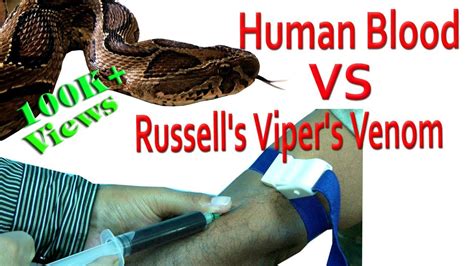 Russells Viper Venom Effects On Human Blood Youtube