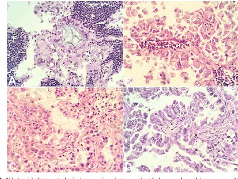 Figure 5 From Troisier Sign And Virchow Node The Anatomy And Pathology