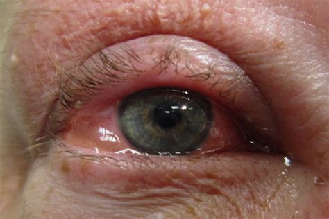 Conjunctivitis Causes And Symptoms Emergency Live