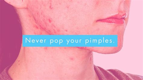 Best Treatments Hormonal Acne On The Chin