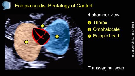 Ectopia Cordis Pentalogy Of Cantrell Youtube