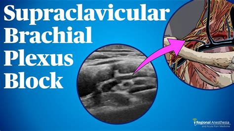 Supraclavicular Brachial Plexus Block Youtube