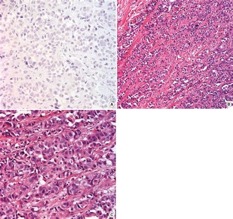 Microscopic Morphology Of Invasive Pleomorphic Lobular Carcinoma Download Scientific Diagram