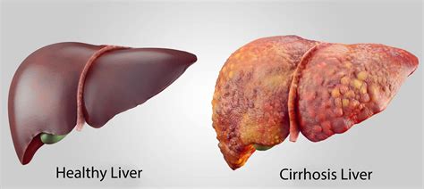 Cirrhosis Of The Liver Gutcare