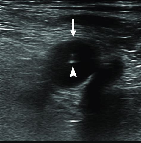 Ultrasound Guided Common Femoral Artery Access Arterial Wall Puncture