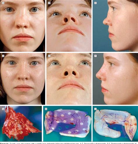 Figure 1 From Extracorporeal Septoplasty For The Markedly Deviated