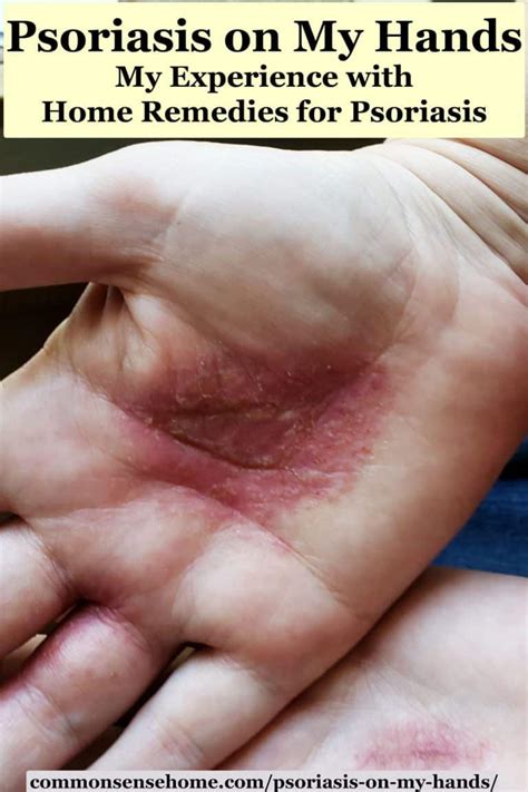 Psoriasis On My Hands My Experience With Home Remedies For Psoriasis