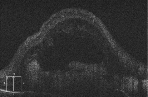 Pseudoxanthoma Elasticum March 2018 Illinois Retina Associates