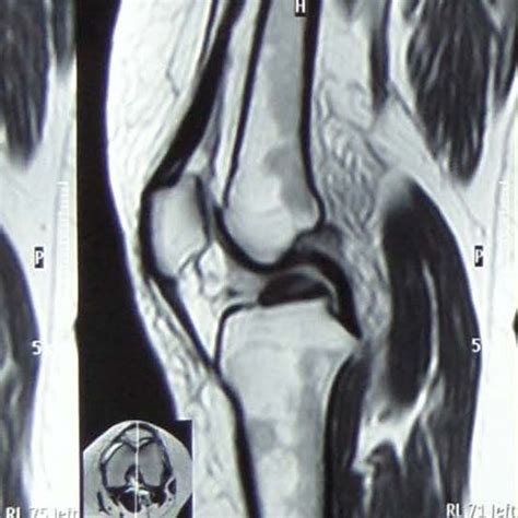 Mri T1 Left Knee Revealed Torn Acl Download Scientific Diagram