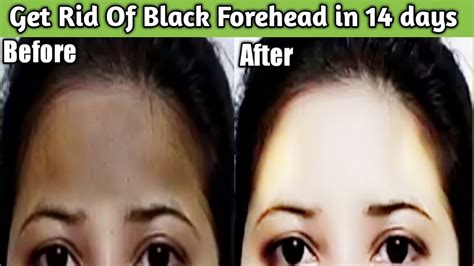 How To Remove Darkness From Forehead In Hindiget Rid Of Black Forehead