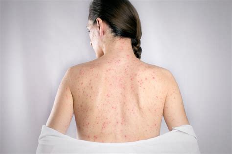 What Is Shingles And How Can I Avoid It Thomas E Sulkowski Md