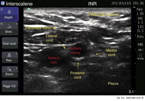 Ultrasoundguided Infraclavicular Brachial Plexus Block