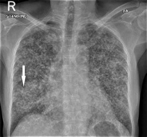 Tb Chest X Ray Chest X Ray Showing Normal Chest And Pulmonary