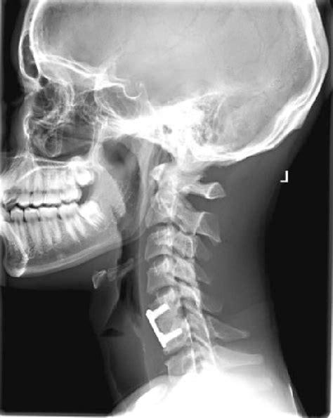 Lateral Cervical Radiograph One Year Postoperatively Reveals Good