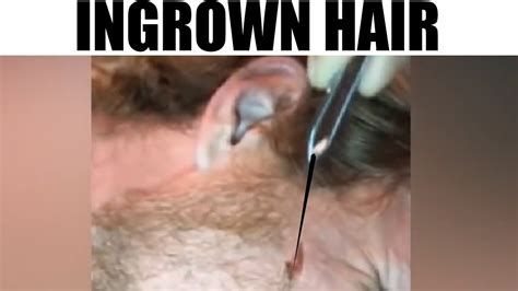 Largest Ingrown Hair Download Ingrown Hair Removal In Mp4 And 3gp