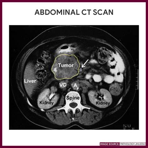 Computed Tomography Ct Scan Nursing Responsibilities Nurseslabs