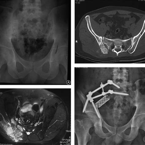 The Types And Cases Of Iliac And Sacral Osteotomy In Nine Patients In