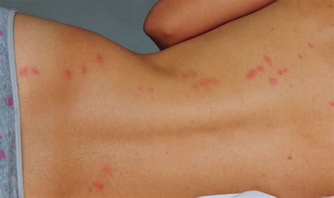 Bed Bug Bites Signs Include Severe Itching Blisters Or Hives