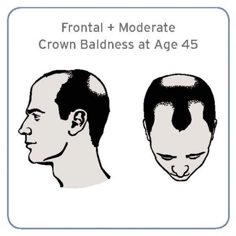 Specific Baldness Pattern Linked With Increased Prostate Cancer Risk