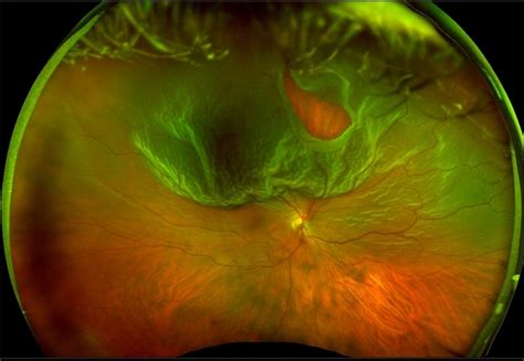 Optos Giant Tear Within Retinal Detachment Retina Image Bank