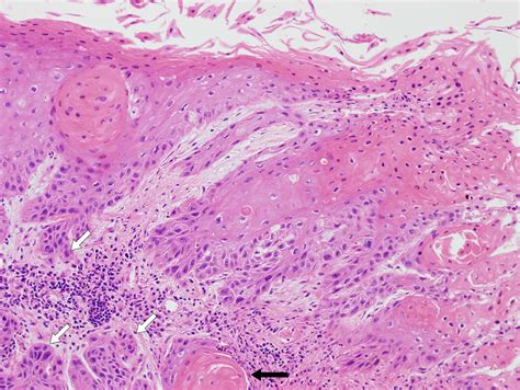 Invasive Squamous Cell Carcinoma Initially Presenting As Laryngeal
