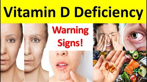 Symptoms And Treatments Of Vitamin D Deficiency