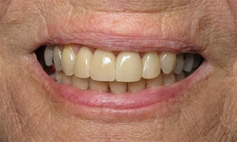 Dental Bridge Front Teeth Before And After Dentists Lake Charles