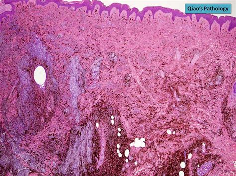 Qiaos Pathology Cellular Blue Nevus Microscopic Photo Sh Flickr
