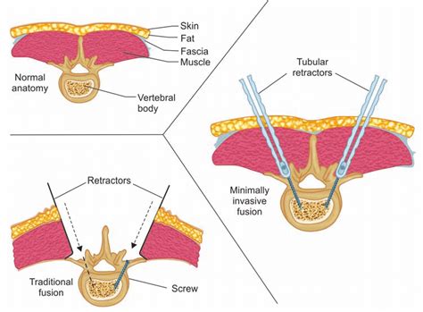 A And B Open Vs Minimally Invasive Surgery Technique For Pedicle Screw
